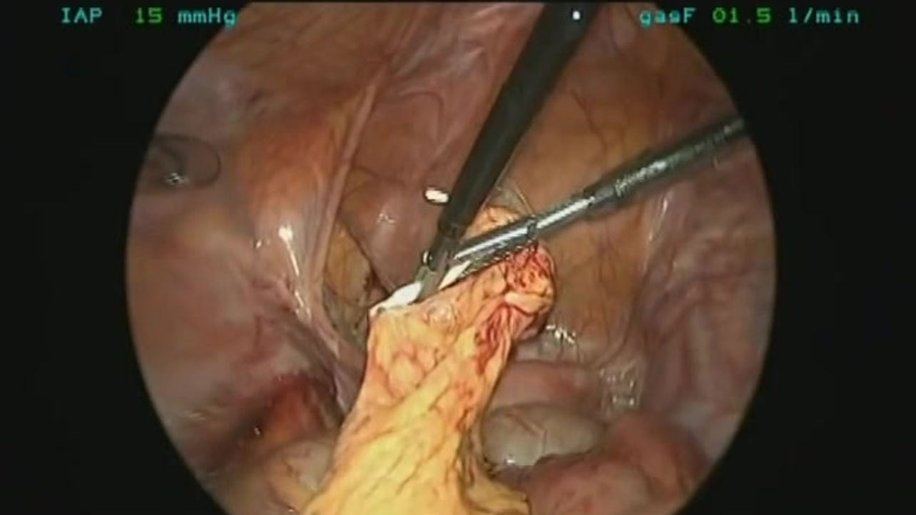 Benign Gynecology